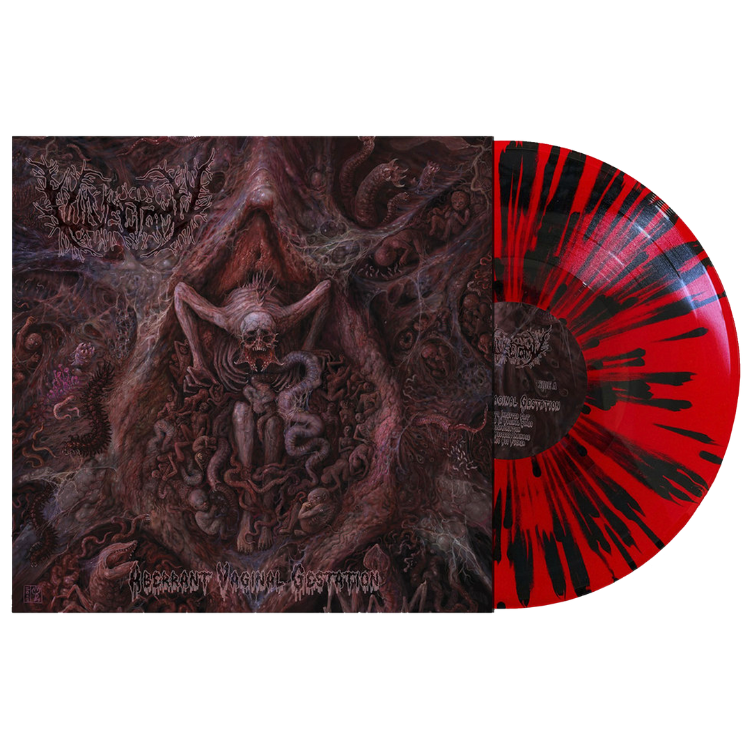 Vulvectomy 'Aberrant Vaginal Gestation' LP