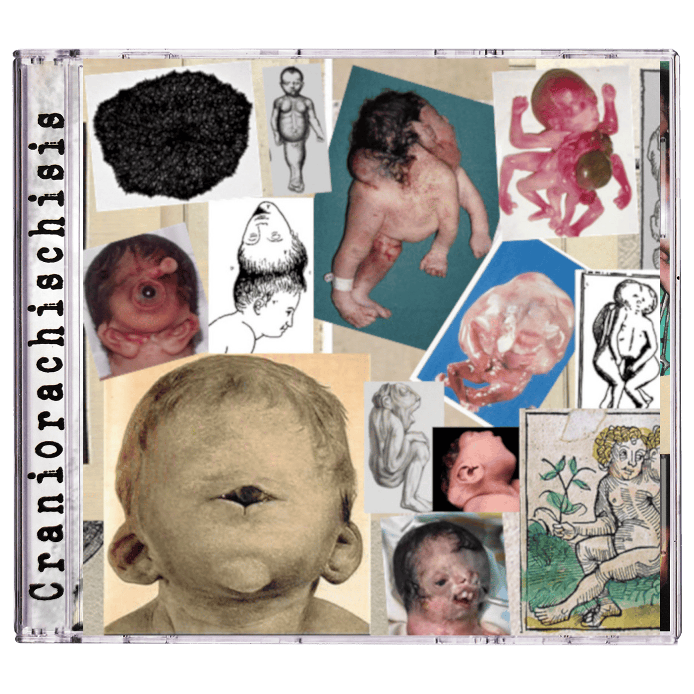 Craniorachischisis 'Craniorachischisis' CD