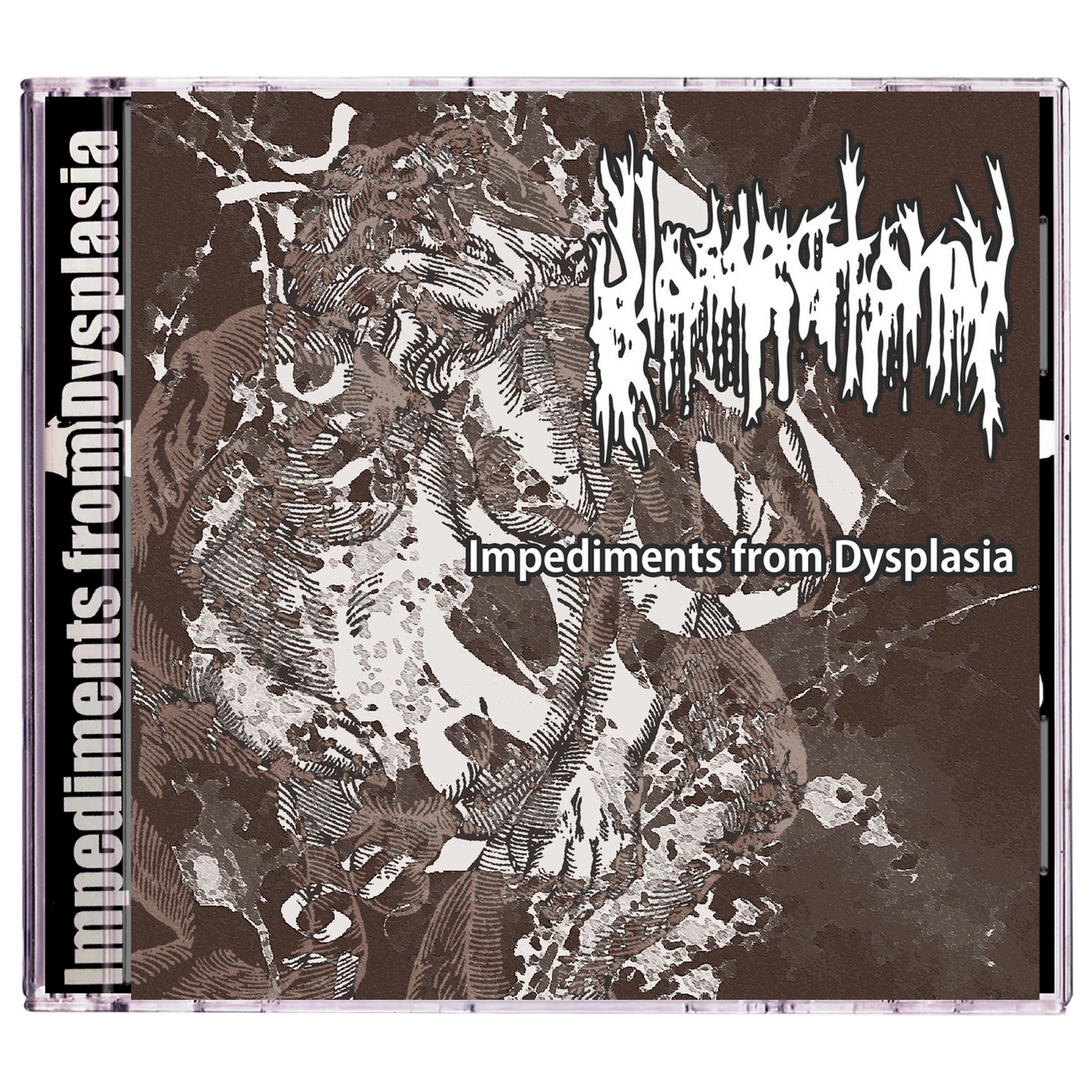 Glossectomy 'Impediments From Dysplasia' CD