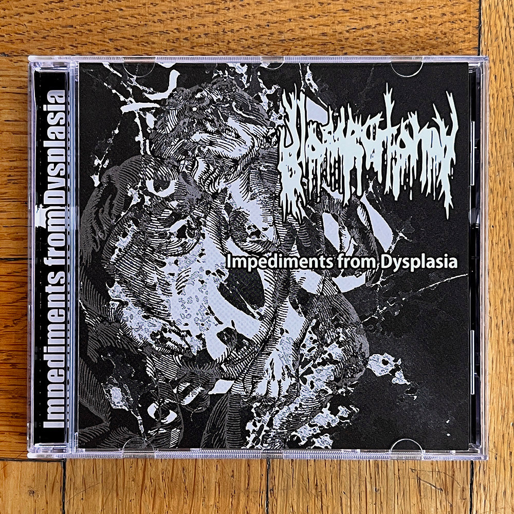Glossectomy "Impediments from Dysplasia" CD