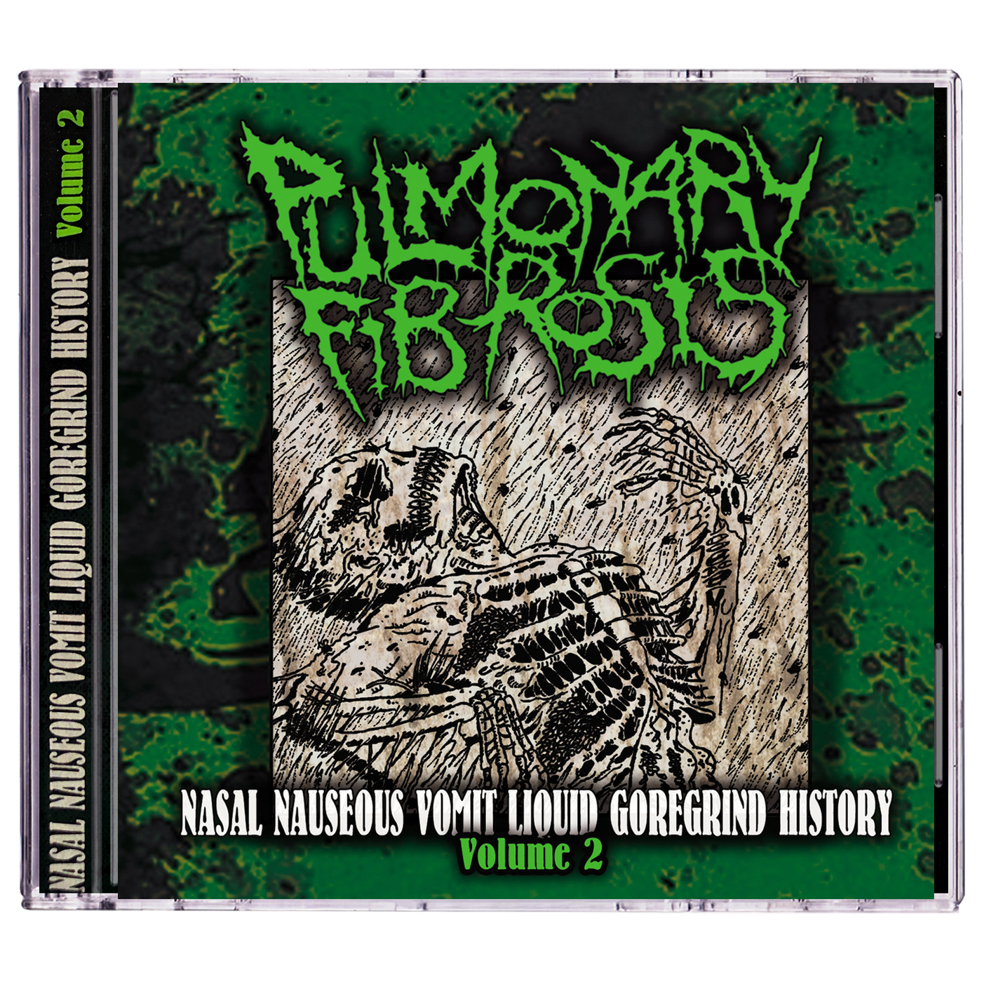 Pulmonary Fibrosis 'Nasal Nauseous Vomit Liquid Goregrind History Volume 2' CD